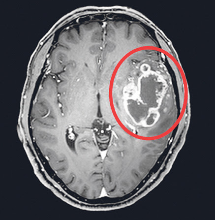 How is a Brain Tumor Diagnosed?
