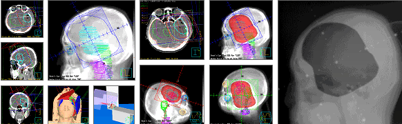 Understanding Radiation Therapy for Brain Tumors