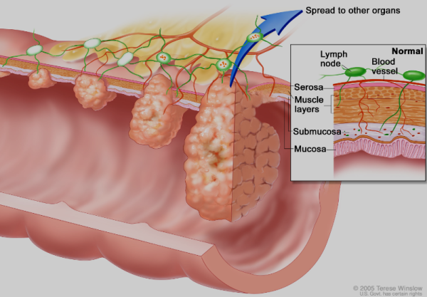 Understanding Colorectal Cancer: A Vital Insight