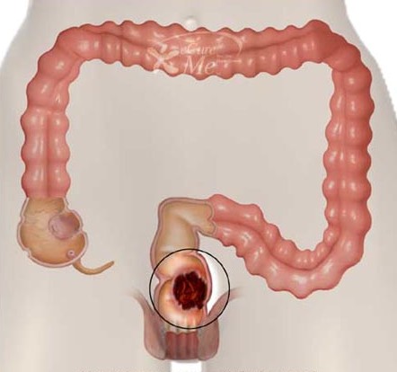 What should I know before surgery for Colorectal Cancer?