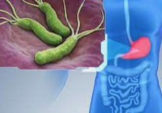 Unveiling the Link: Helicobacter pylori Infection and the Risk of Stomach Cancer