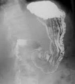 Shedding Light on Stomach Cancer: Detecting Through Barium Upper GI Radiographs