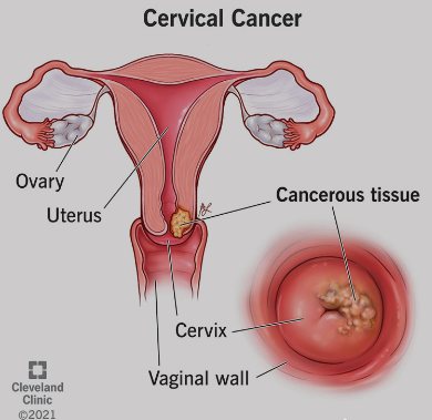 Decoding Diagnosis: Unraveling the Path to Detecting Cervical Cancer