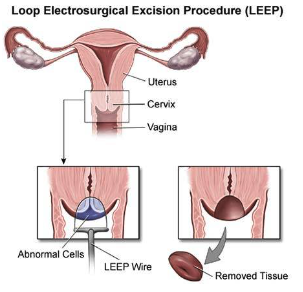 Precision in Practice: Understanding LEEP for Cervical Cancer Diagnosis