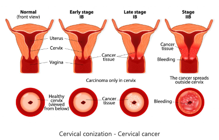 Precision and Clarity: Unraveling the Significance of Conization in Cervical Cancer Diagnosis