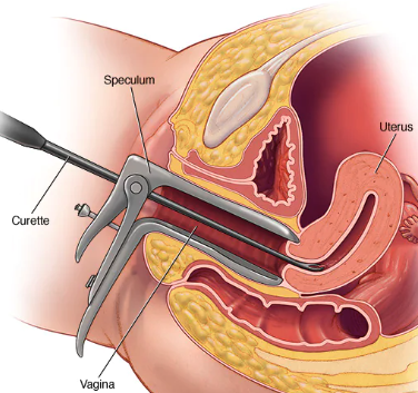 Navigating Diagnostic Clarity: Understanding Dilation and Curettage (D&C) for Cervical Health