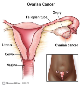 Navigating the Side Effects of Ovarian Cancer Treatment