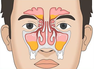 Anticipating Future Sinus Infections: Understanding Prevention and Treatment