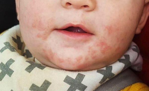 How to Treat Hives in Your Baby