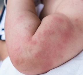 Navigating Hives in Babies: When to Seek Medical Attention