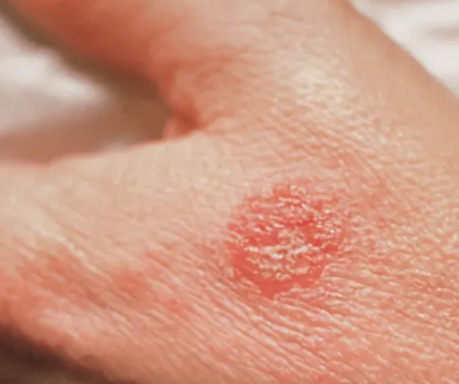 Unraveling the Itch: Eczema as a Potential Culprit