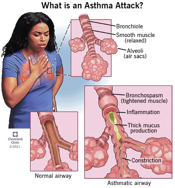 Unmasking Asthma: Understanding a Chronic Respiratory Challenge