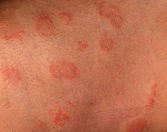 Unraveling the Basics: Understanding Ringworm and Its Variations