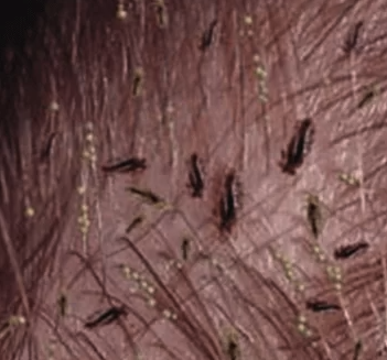 Tips to Prevent Recurring Head Lice in Your Baby