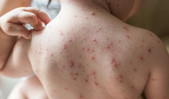 Understanding Baby's Spotty Red Rash: Could it be Chickenpox?