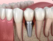 Debunking the Myth: Is Dental Implant Surgery Painful?