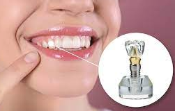 Navigating Dental Implant Restoration: Who Can Restore Your Smile?