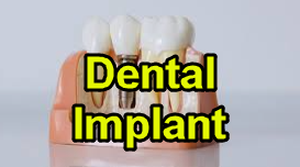 Understanding Who Can Place Dental Implants: Your Guide to Expert Care