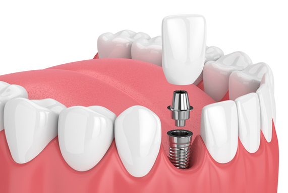 Exploring Implant Dentistry: Restoring Smiles with Precision