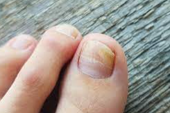 Treating Toenail Fungus Safely During Pregnancy