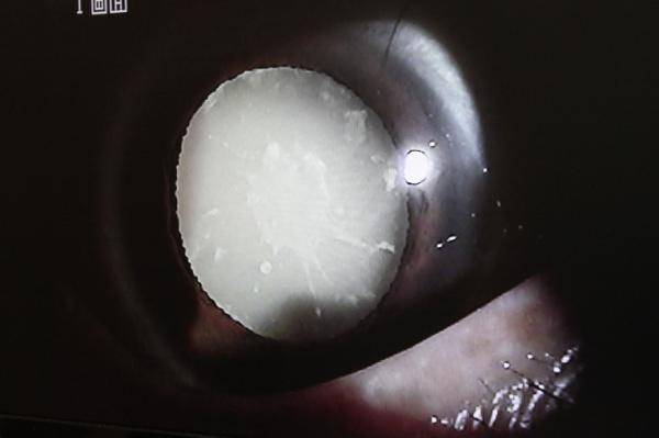 Can cataract surgery be done with laser?