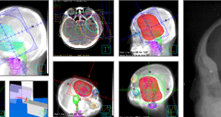 Understanding Radiation Therapy for Brain Tumors