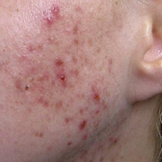 Demystifying Acne: Understanding Its Root Causes