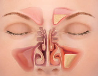 How long does sinusitis have to be treated?