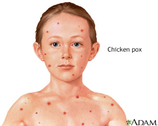 Is there any way to prevent chicken pox?