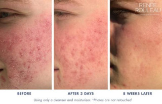 How long before I see a visible result from using my acne medication?