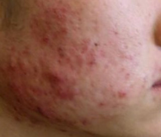 Can anything be done about scarring caused by acne?