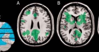 Does Lyme disease affect mental functioning?