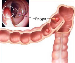 How do I prevent colon-rectal (colorectal) cancer?