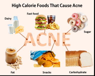 Oily Food, Greasy Food and Acne