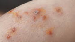 Shielding Others - Preventing the Spread of Baby's Impetigo