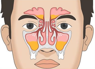 Anticipating Future Sinus Infections: Understanding Prevention and Treatment