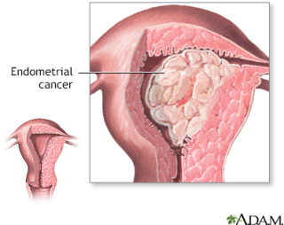 Do we know what causes endometrial cancer?