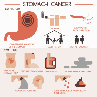 How Previous Stomach Surgery Might Increase Stomach Cancer Risk