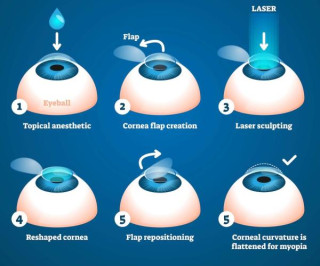 What is LASIK ?