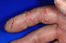 Unraveling the Enigma: Understanding the Causes of Eczema