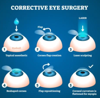 LASIK Surgery: Should You Treat Both Eyes Simultaneously?