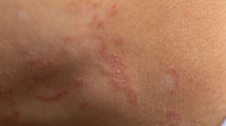 How should I treat ringworm?