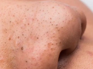 Understanding Blackheads and Scarring: What You Need to Know