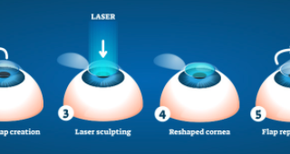 What is LASIK ?