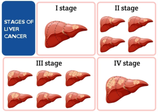 Demystifying Liver Cancer: Understanding the Basics