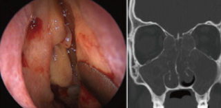 Exploring the Link Between Asthma and Sinusitis: A Surprising Insight