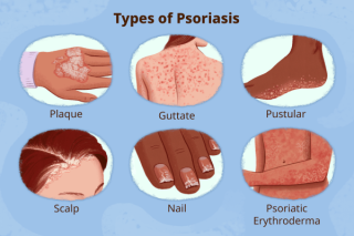 What causes psoriasis?