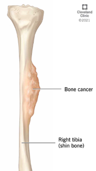 How is bone cancer diagnosed?