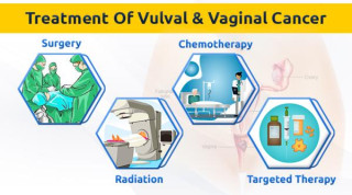 Exploring Three Vulvar Cancer Treatments