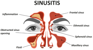 Debunking the Myth: Alcohol and Sinusitis